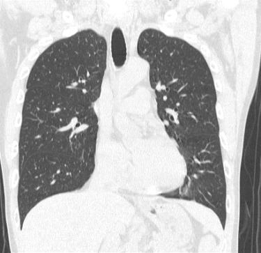 全身CT・肺がんドック