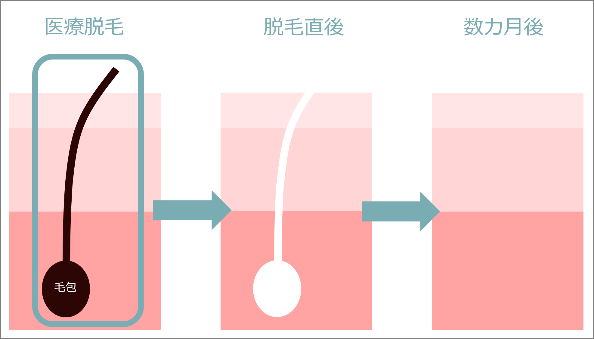 痛みの少ない医療脱毛を目指してレーザー脱毛│全身脱毛│豊橋